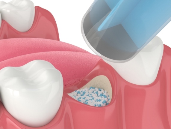 Animated bone grafting material being placed into socket where tooth is missing