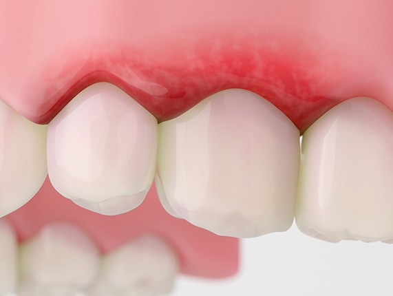 Illustration of red, inflammed gums
