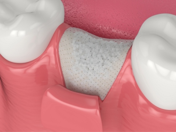 Animated dental bone grafting material being placed in socket of missing tooth