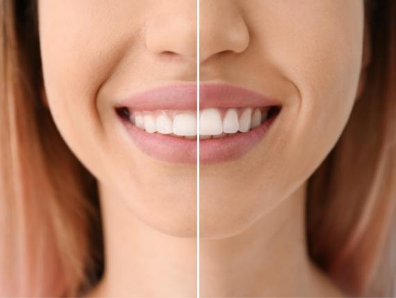 Close up of smile before and after gum recontouring
