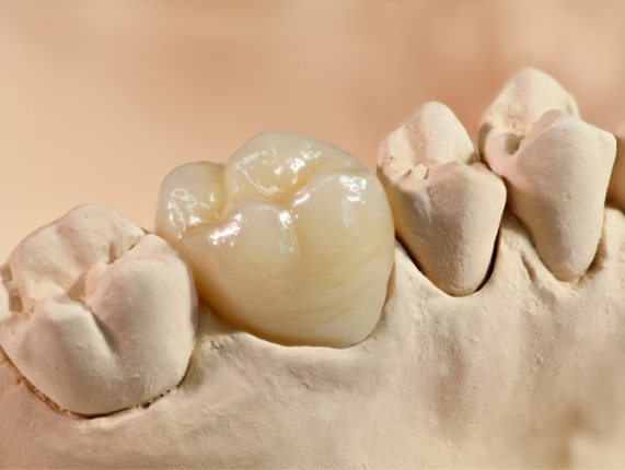 Dental crown resting on tooth in model of lower arch of teeth