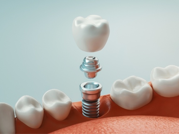 Animated dental implant with dental crown being placed in the lower jaw