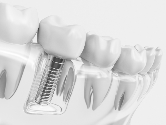 Animated model of dental implant in the lower jaw