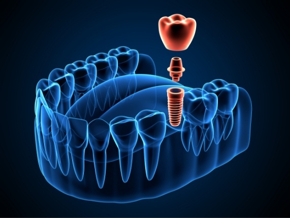 Animated model of dental implant being placed in lower jaw