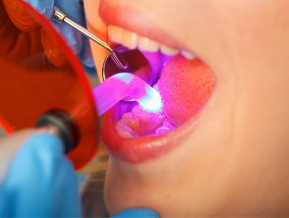Close up of woman receiving direct bonding from cosmetic dentist