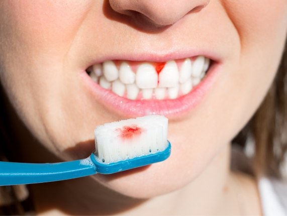 Close up of person holding bloody toothbrush outside of their mouth with bleeding gums