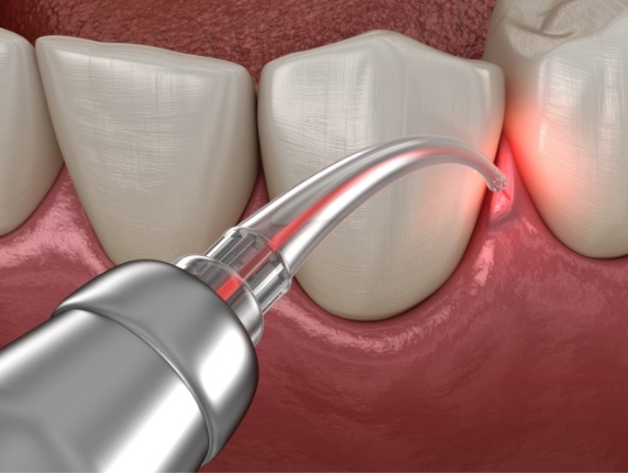 Close up of animated soft tissue laser treating gum disease
