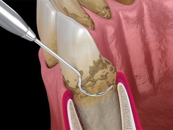Illustration of dental scaler cleaning beneath the gumline.