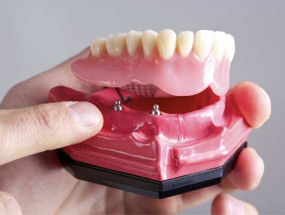 Hand holding a model of an All on 4 implant denture