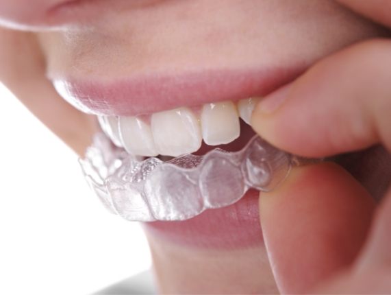 Close up of person placing Invisalign clear aligner over their teeth