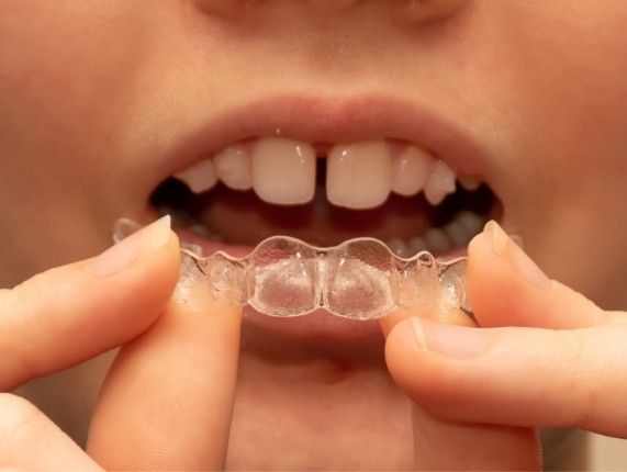 Close up of person placing Invisalign tray in their mouth