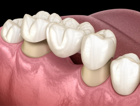 Animated dental bridge replacing a missing tooth in West Orange