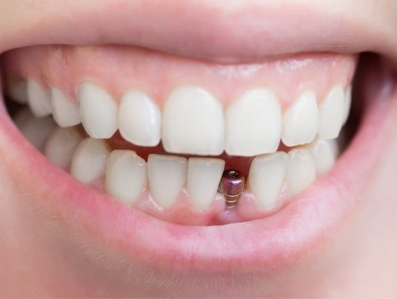 Close up of person smiling with visible dental implant abutment