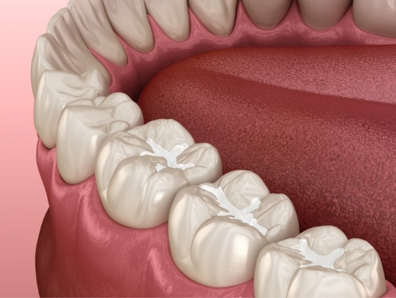 Animated row of teeth with dental sealants