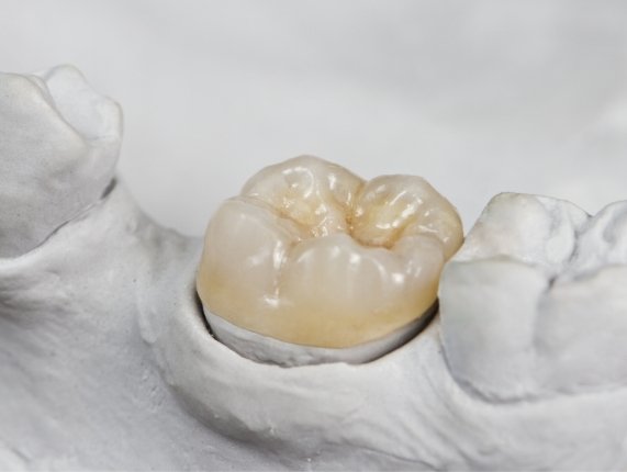Dental crown resting on tooth in model of lower arch of teeth