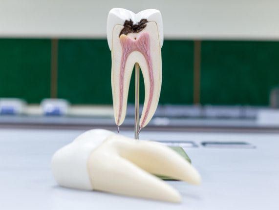 Model of damaged tooth that needs a root canal