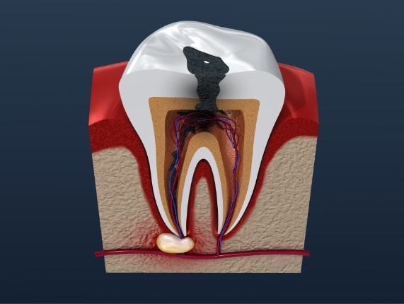Animated infected tooth needing root canal treatment