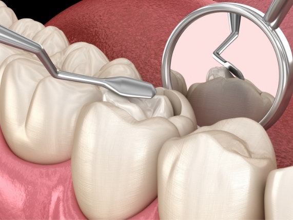 Close up of animated tooth receiving a tooth colored filling in West Orange