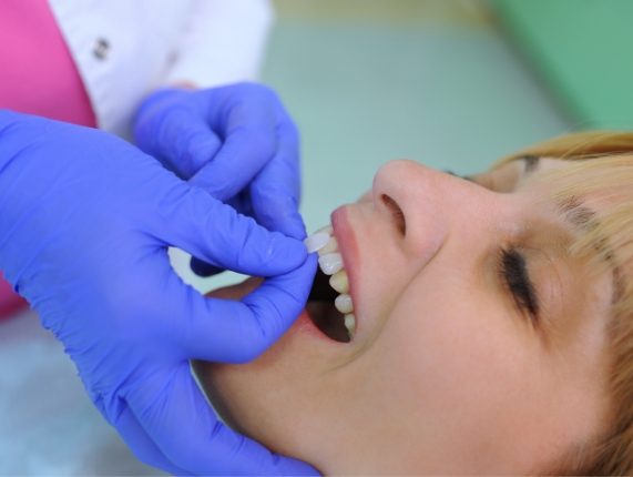 Dentist placing veneer over the front tooth of a patient