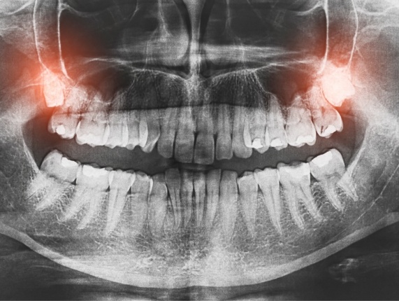 Dental x rays with wisdom teeth highlighted red