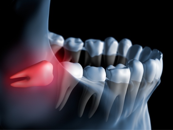 Animated impacted wisdom tooth highlighted red and pushing against back molar