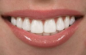 person with straight teeth smiling