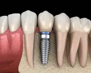 Dental implant and teeth