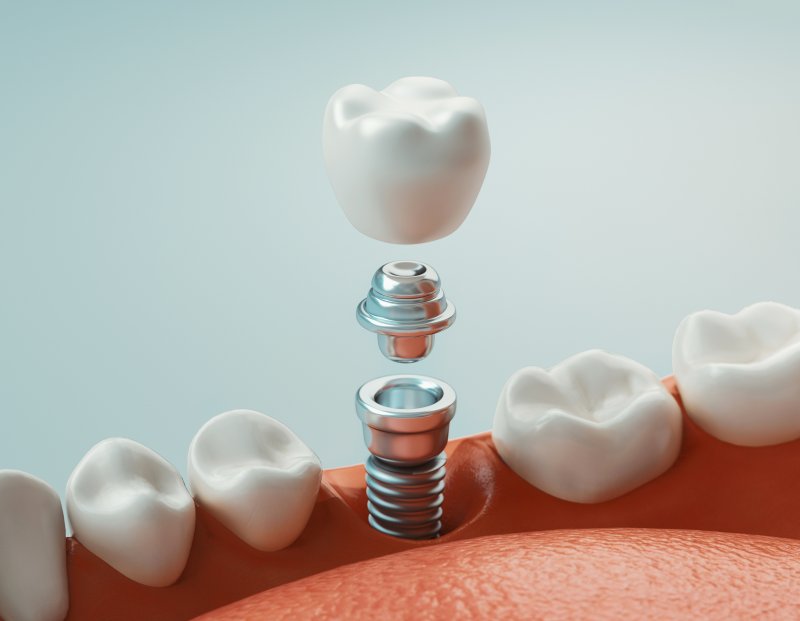 A 3D illustration of a dental implant’s various parts