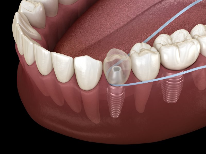 An illustration of flossing dental implants in West Orange