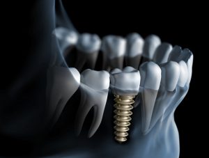 Dentla implant in jaw