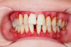a person with recessed gums due to gum disease in West Orange