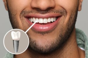 Man smiling after getting a dental implant
