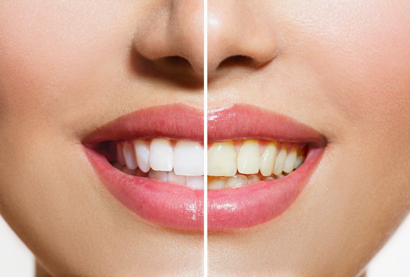 Before and after pictures of teeth whitening
