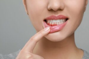 Woman pulling down bottom lip to reveal red gums.