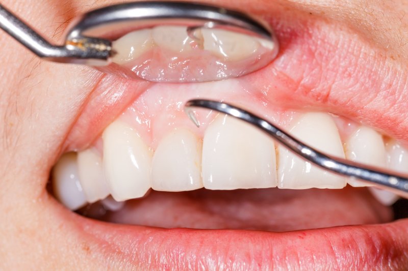 A dentist examining a patient with gum disease