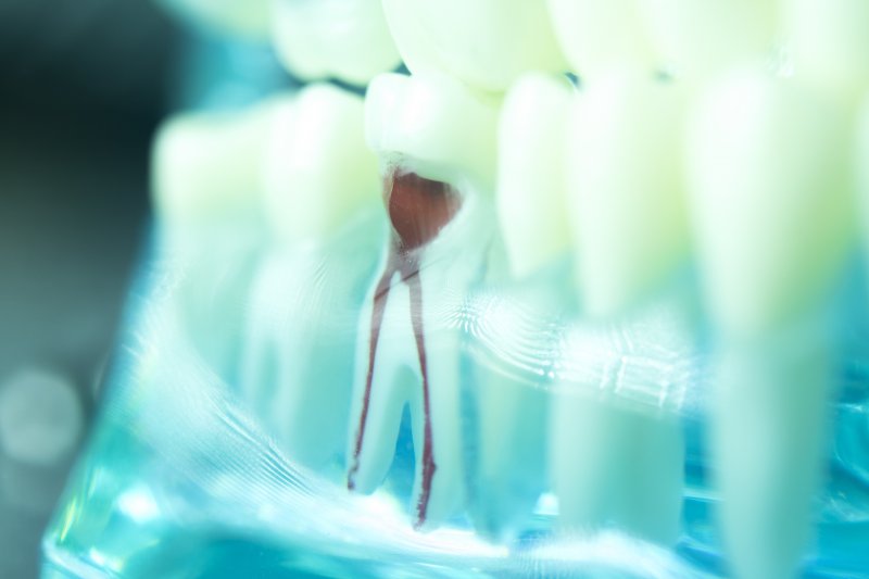 Root canal