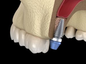 Dental implant placed after a bone graft in West Orange. 