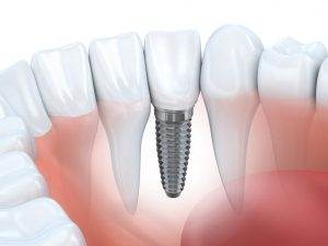 How can you improve your jaw strength and fill in the gaps in your smile? With dental implants in West Orange from D&G Dental. 