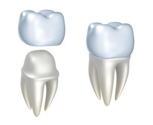 Your dentist in West Orange, NJ discusses dental crowns.