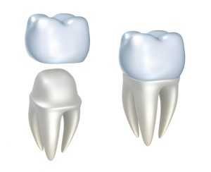 Your dentist in West Orange, NJ discusses dental crowns.