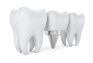 Your dentist for dental implants in Caldwell.