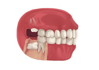 illustration of an impacted wisdom tooth