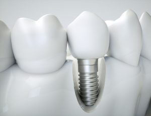 Close up of dental implant in West Orange 